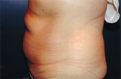 Liposculpture/Liposuction Patient 90722 Photo 3