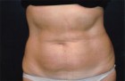 Liposculpture/Liposuction Patient 90722 Photo 2