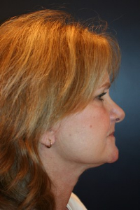 Facelift Patient 50728 Photo 2