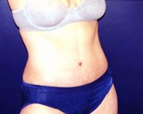 Tummy Tuck Patient 67379 Photo 4