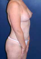 Liposuction Patient 89213 Photo 6