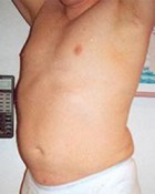 Male Liposuction Patient 54678 Photo 2