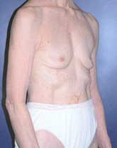 Breast Augmentation Patient 22537 Photo 3