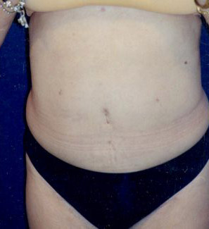 Tummy Tuck Patient 33040 Photo 2