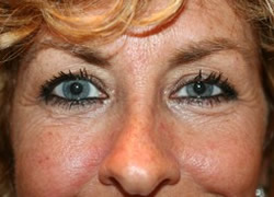 Brow Lift Patient 27228 Photo 3