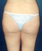 Liposculpture/Liposuction Patient 73931 Photo 4