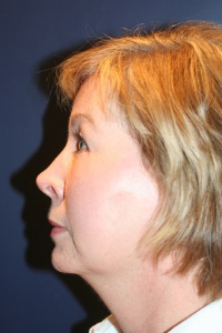 Facelift Patient 61471 Photo 4