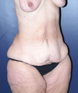 Massive Weight Loss Patient 70154 Photo 1