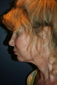 Facelift Patient 27535 Photo 3