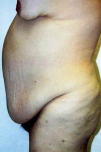 Liposculpture/Liposuction Patient 89461 Photo 1