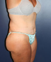 Massive Weight Loss Patient 11895 Photo 4