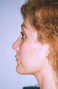 Chin Augmentation Patient 48467 Photo 2