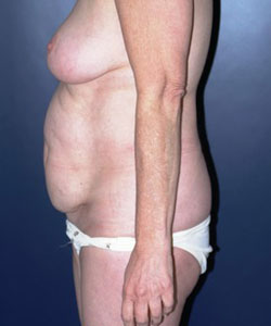 Tummy Tuck Patient 36848 Photo 3