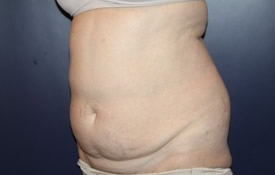 Tummy Tuck Patient 57518 Photo 1