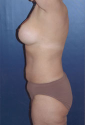 Breast Augmentation Patient 50635 Photo 4