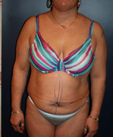 Tummy Tuck Patient 56322 Photo 1