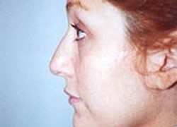 Eyelid Surgery Patient 71786 Photo 1