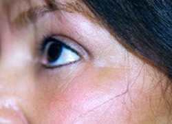 Eyelid Surgery Patient 66205 Photo 4