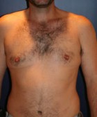 Male Liposuction Patient 48056 Photo 2