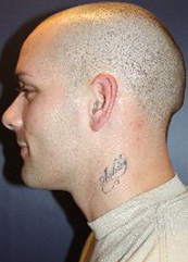 Tattoo Removal Patient 58196 Photo 1