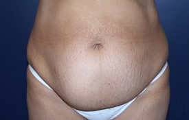 Tummy Tuck Patient 57392 Photo 1