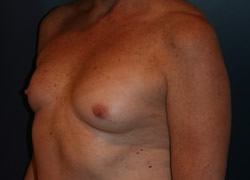 Breast Reconstruction Patient 63352 Photo 3