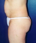 Tummy Tuck Patient 21721 Photo 1