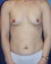 Breast Augmentation Patient 62551 Photo 5