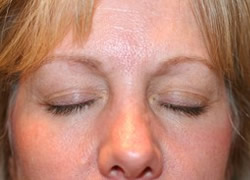 Eyelid Surgery Patient 21746 Photo 3