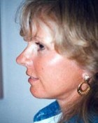 Facelift Patient 20587 Photo 2