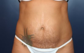 Tummy Tuck Patient 88556 Photo 1