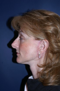 Brow Lift Patient 62240 Photo 2