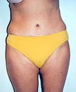 Tummy Tuck Patient 97964 Photo 2