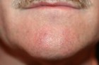 Laser Telengiectasia Blood Vessels Patient 20951 Photo 2