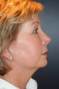 Brow Lift Patient 97993 Photo 2