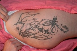 Tattoo Removal Patient 28810 Photo 3