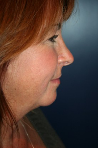 Brow Lift Patient 52476 Photo 3