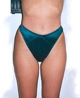 Liposculpture/Liposuction Patient 94726 Photo 2