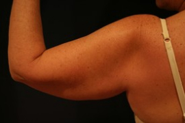 Arm Liposuction and Arm Brachioplasty Patient 57766 Photo 1