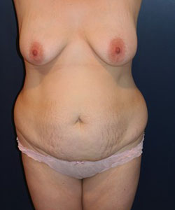 Tummy Tuck Patient 28531 Photo 3