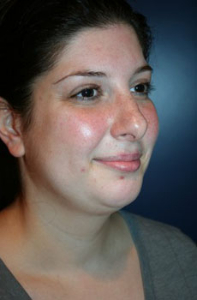 Chin Augmentation Patient 99366 Photo 1