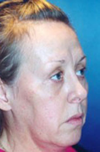 Chin Augmentation Patient 54349 Photo 3