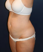 Tummy Tuck Patient 96601 Photo 3