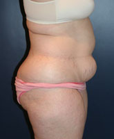 Liposculpture/Liposuction Patient 36058 Photo 1