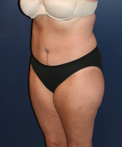 Tummy Tuck Patient 50220 Photo 2