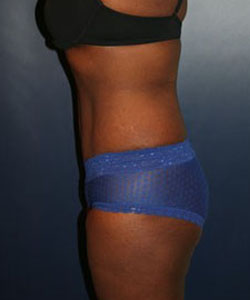 Tummy Tuck Patient 85564 Photo 2