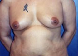 Breast Augmentation Patient 72584 Photo 1