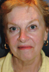 Facelift Patient 85820 Photo 3