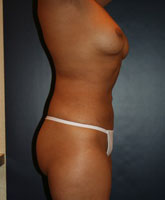 Liposculpture/Liposuction Patient 28942 Photo 4