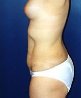 Liposculpture/Liposuction Patient 18798 Photo 4